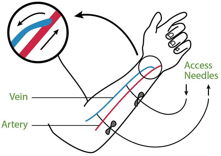 A diagram of an AV fistula.
