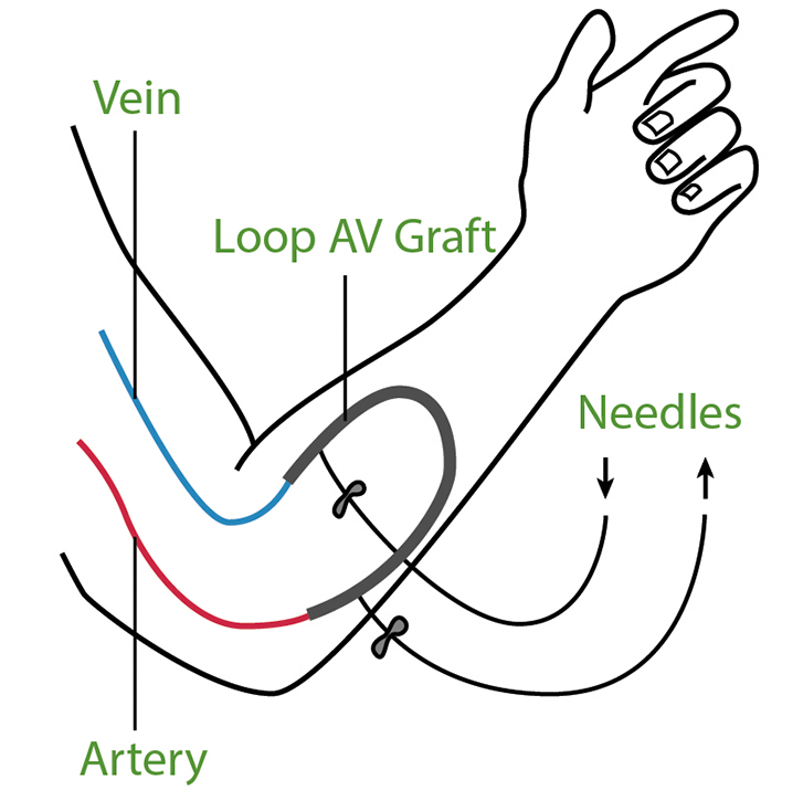 A diagram of an AV graft.