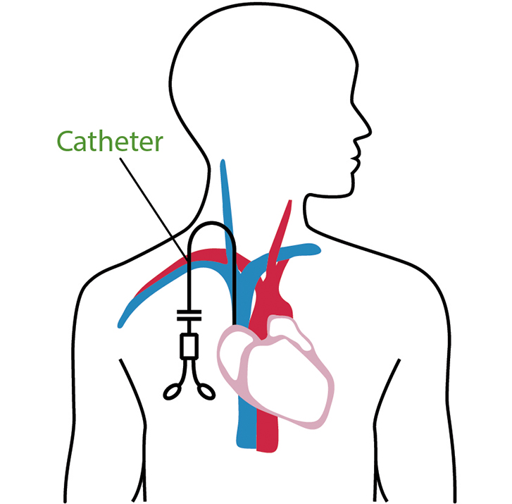 A diagram of a central venous catheter.